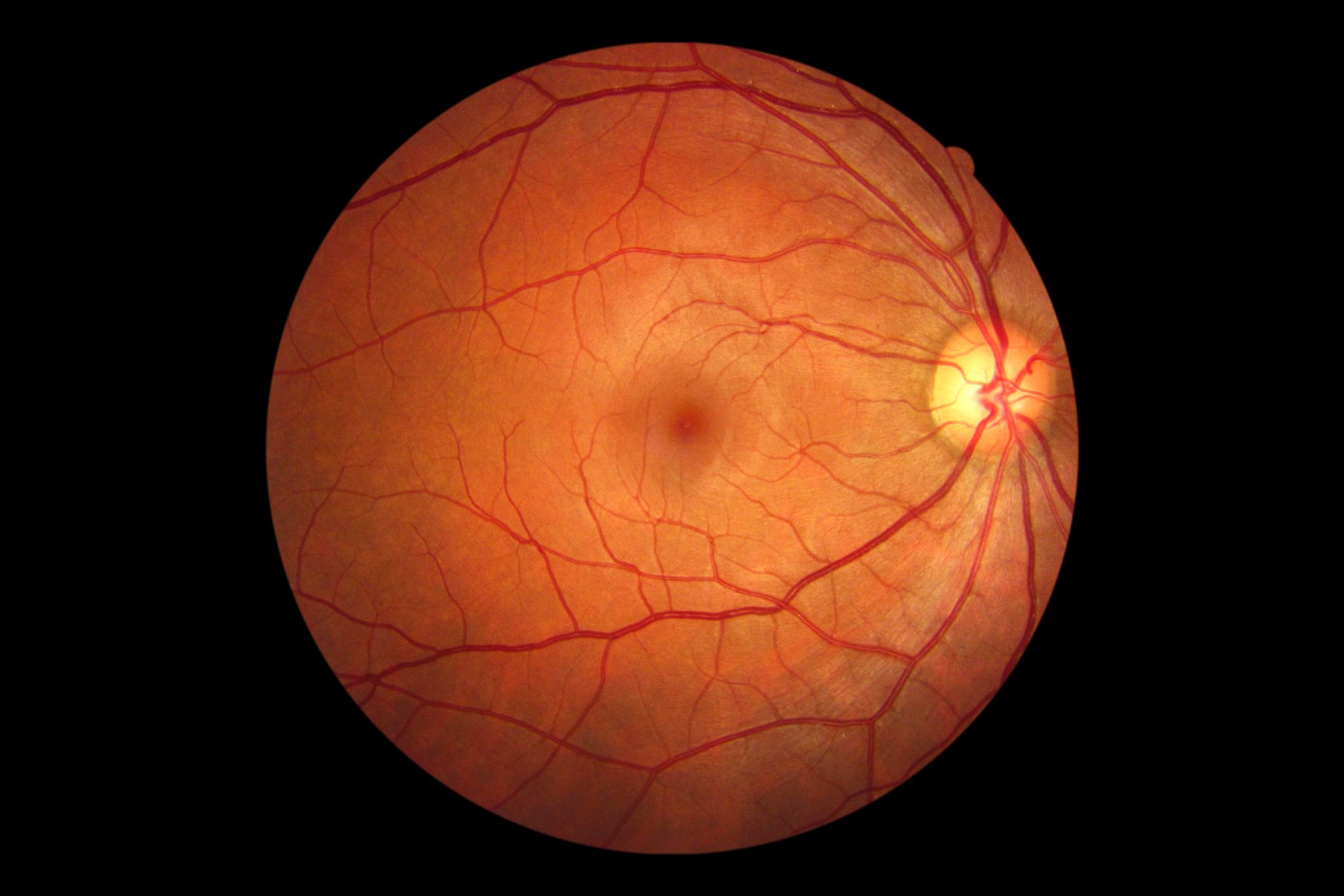 Retinal Fundus Images for Diabetic Retinopathy